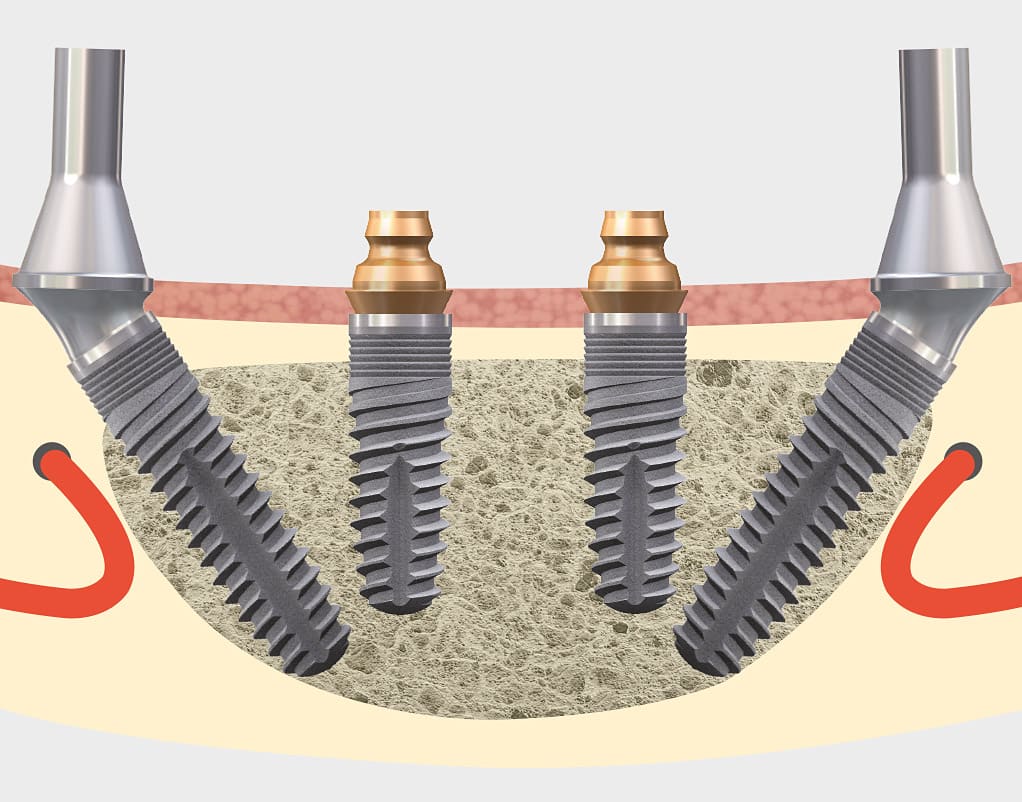 blueSKY - Tissue related implant management