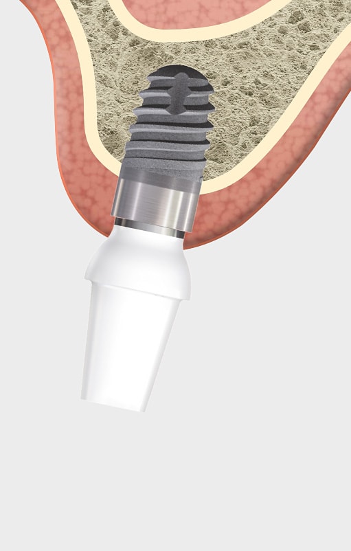 classicSKY - Tissue related implant management