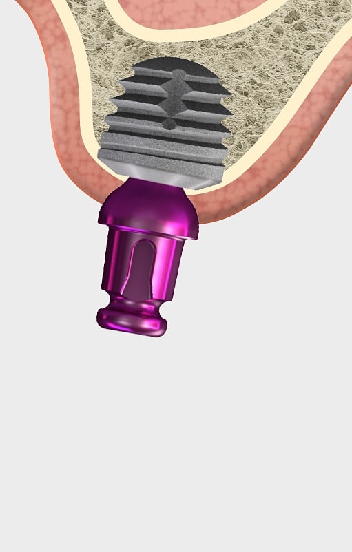 copaSKY Ultra Short- Tissue related implant management