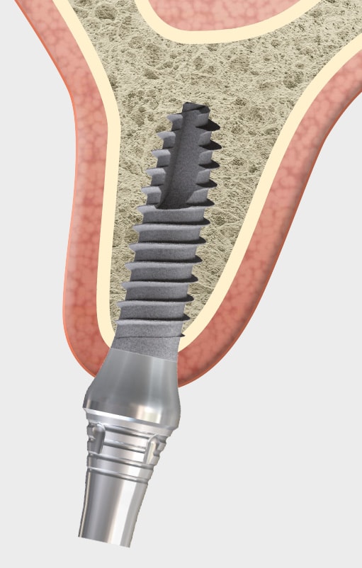 mini1sky 3.2 - Tissue related implant management