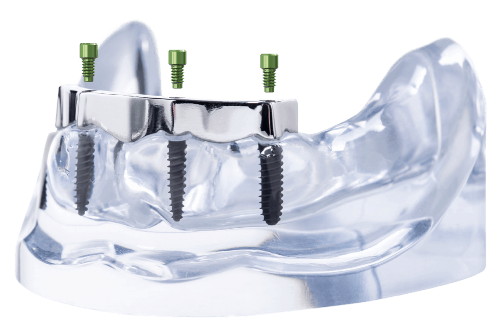 CAD/CAM manufactured bars