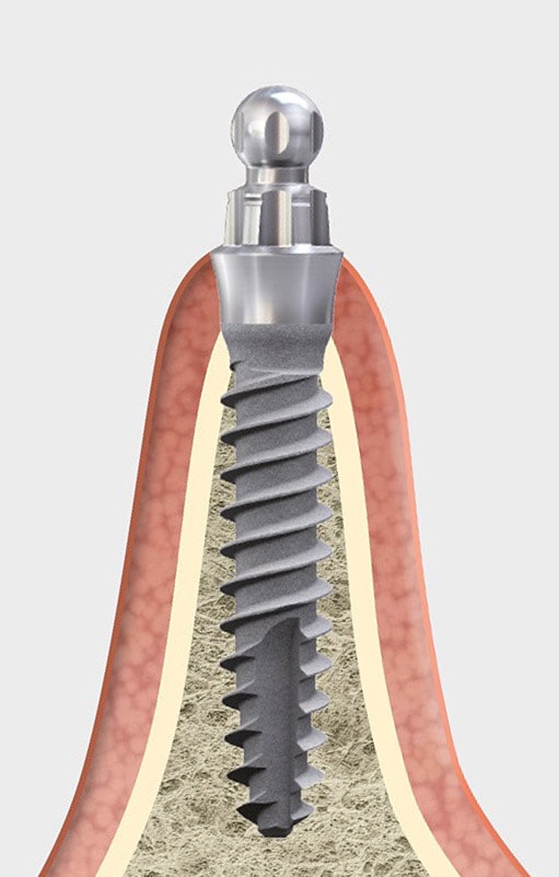 mini1sky 2.8 tissue related implant management