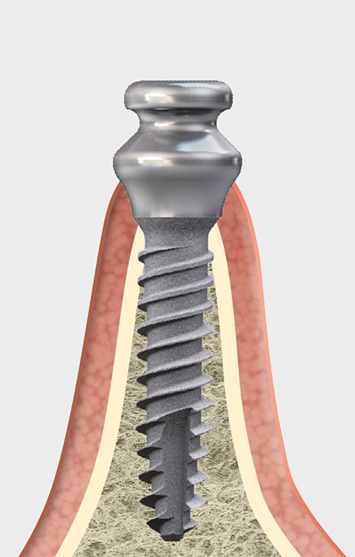 mini2sky tissue related implant management