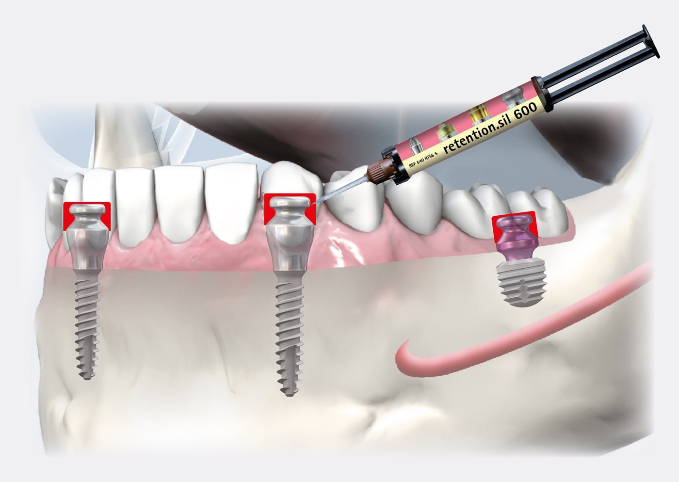 SKYonics Prosthesis retention.sil