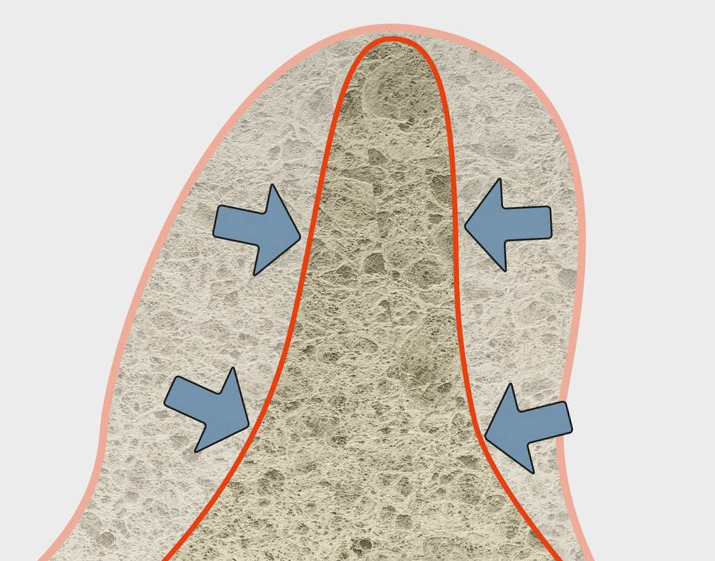 slim implant by bredent-medical