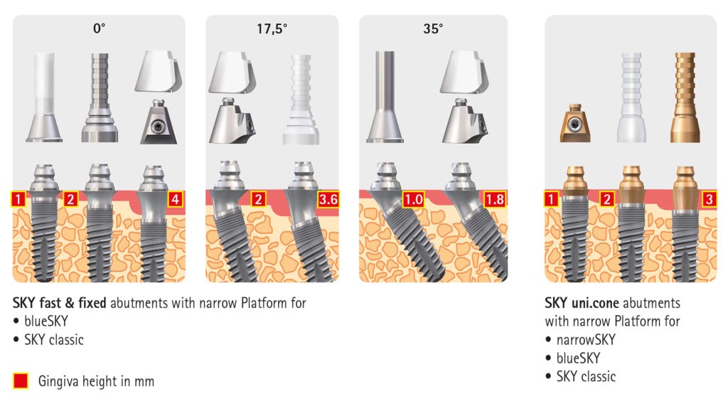 SKY fast&fixed retained bridge abutment