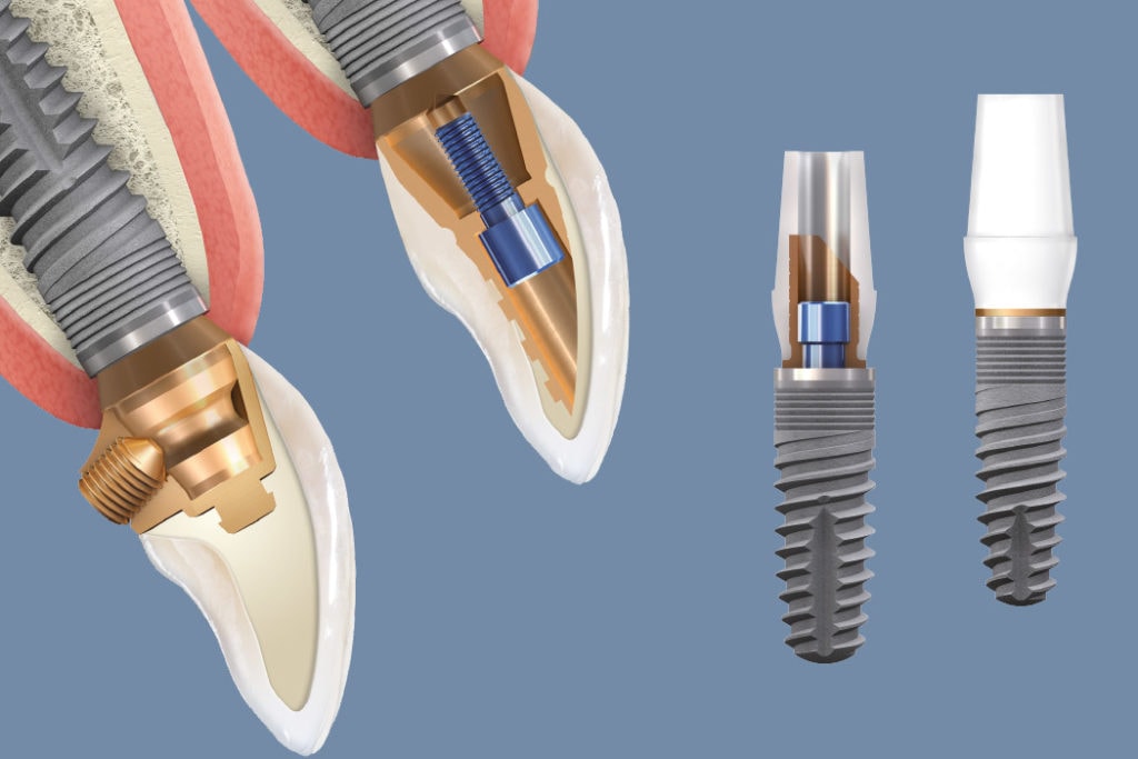 SKY prosthetics image