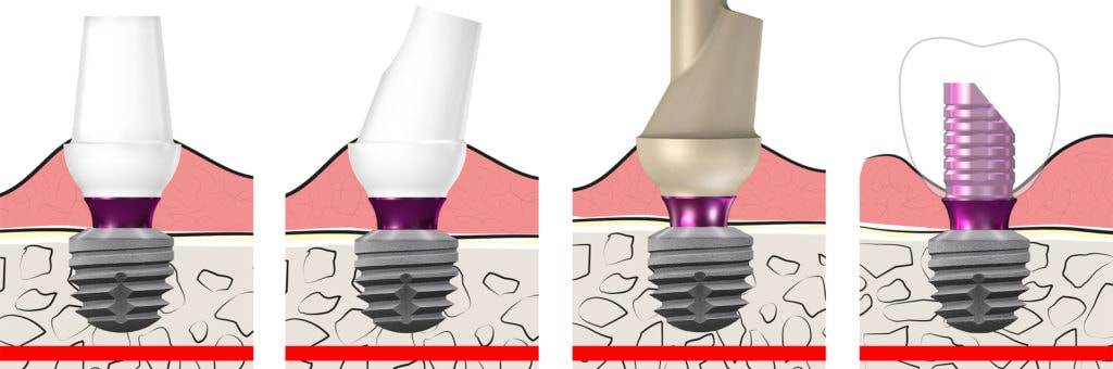 copaSKY BioHPP Elegance Abutments All