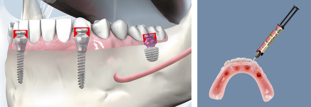 copaSKY TiSi.snap retention.sil