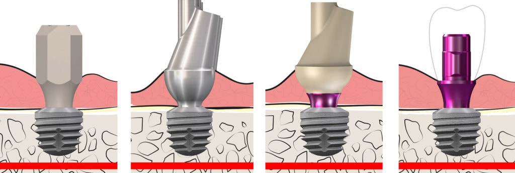 copaSKY Digital Open System All Prosthetics