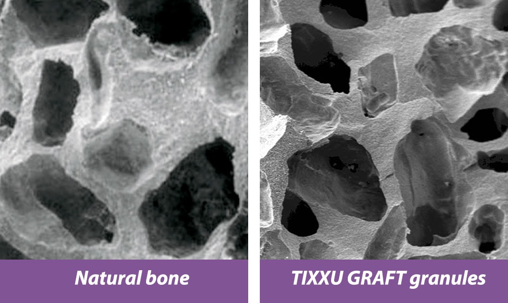 Natural Bone Vs TIXXU GRAFT