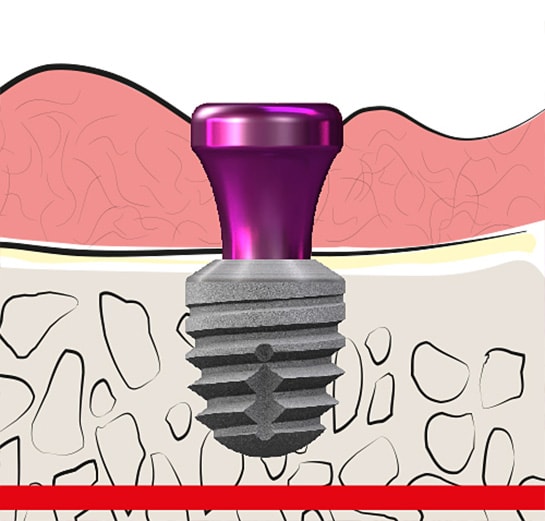 1x Reconnection Abutments