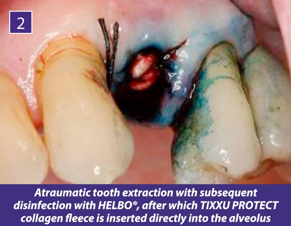TIXXU Protect Clinical Case 2