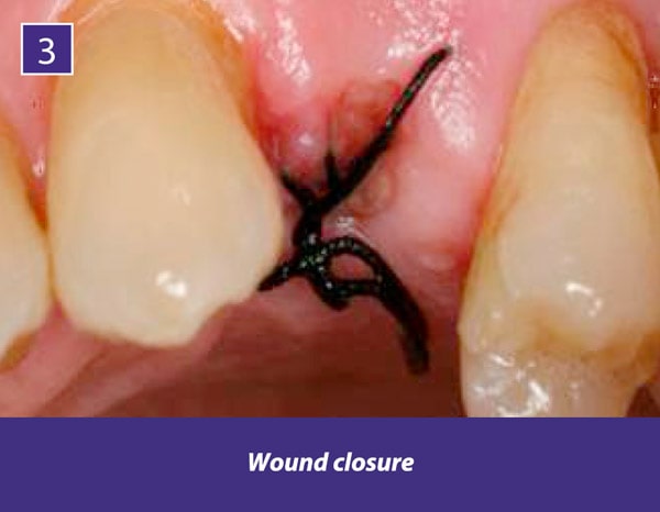 TIXXU Protect Clinical Case 3