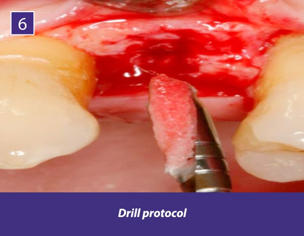 TIXXU Protect Clinical Case 6