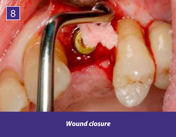 TIXXU Protect Clinical Case 8