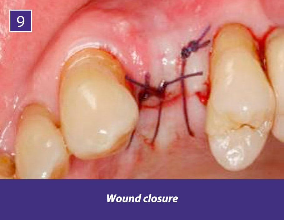 TIXXU Protect Clinical Case 9