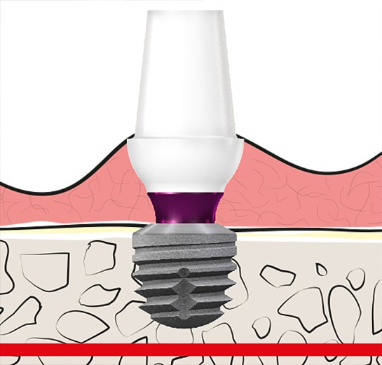 No Reconnection Abutment