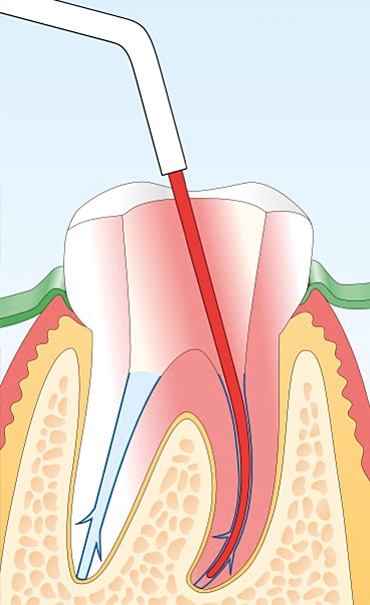 Endodontie (orthograde)